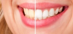 5 ways to keep your teeth white after a whitening treatment