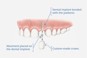 What are Dental Implants?