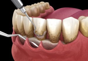 patient getting periodontal treatment