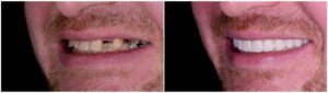 dental implants teeth before and after