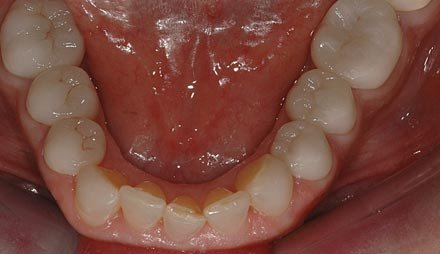 Side view after cosmetic dentistry showing restored front teeth.