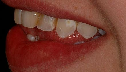 Before cosmetic dentistry showing stained and uneven front teeth.