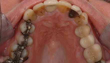 Before smile makeover showing worn and discolored front teeth.